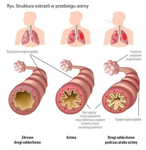 Astma Oskrzelowa Przyczyny Objawy I Sposoby Leczenia Hot Sex Picture