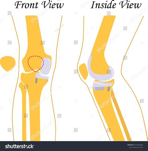 Knee Replacement Joint Prosthetics Knee Endoprosthesis Stock Vector