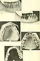 categoryhuman dentition wikimedia commons