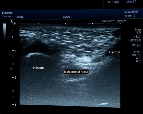 Randomized Controlled Trial Rct Comparing Ultrasound Guided Pudendal