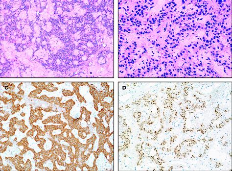 Histologic Examination Of The Tumor Revealed A Monotonous Proliferation