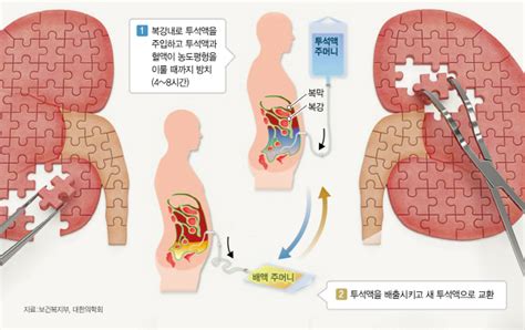 만성신부전 투석방법 아는 것이 藥 서울경제