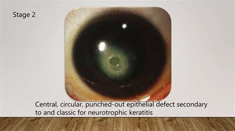 Neurotrophic Keratopathy Ppt