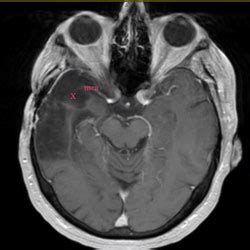 Low Grade Astrocytoma - Stechison Neurosurgery Atlanta, LLC