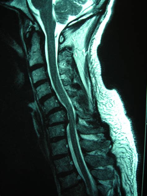 Canal cervical étroit Neurochirurgien Pau Neuropôle Pyrénées