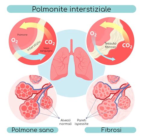 Polmonite Interstiziale Cause Sintomi Sopravvivenza E Cura