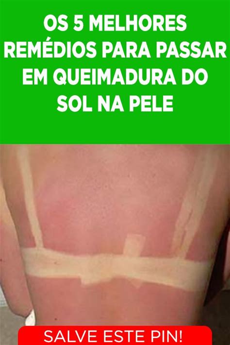 5 Remédios Caseiros Para Passar Na Queimadura Da Pele Causadas Pelo