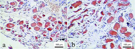 Distal Tibial Biopsy Higher Magnification Congo Red Stain 400×