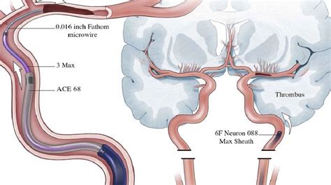 Thrombectomy definition, mechanical & surgical thrombectomy