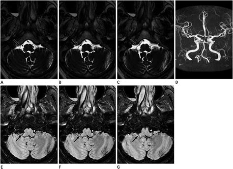 Glossopharyngeal Neuralgia With Syncope Caused By Neurovascular