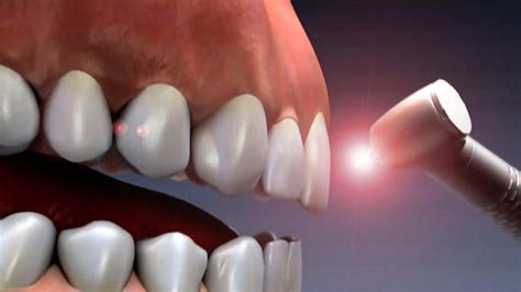 New Infrared Laser Technique Allows Teeth To Regrow And Repa