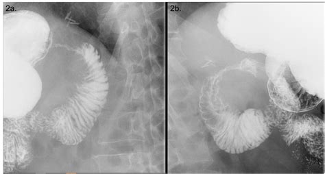 Gastric Outlet Obstruction Masquerading As Gastroparesis Redundant Duodenal Mucosa Successfully