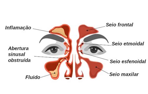 Sinusite Ataca O Ouvido - O que é Sinusite, Causas, Sintomas e Possíveis Tratamentos | Saúde