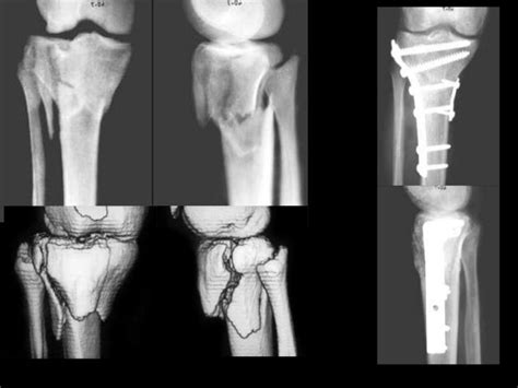 Vista De Errores De Osteosíntesis En Fracturas Laterales De Cadera