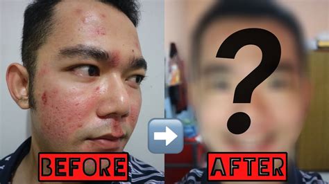 hasilnya ternyata laser rf ematrix  dokterkulitku alvlog