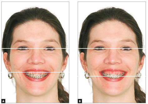 Scielo Brazil Occlusal Plane Canting A Treatment Alternative Using