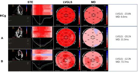 Figure 1 From Speckle Tracking Echocardiography Predicts Adverse Left