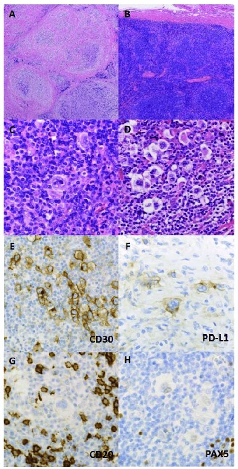 Histological And Immunohistochemical Features Of Nodular Sclerosis