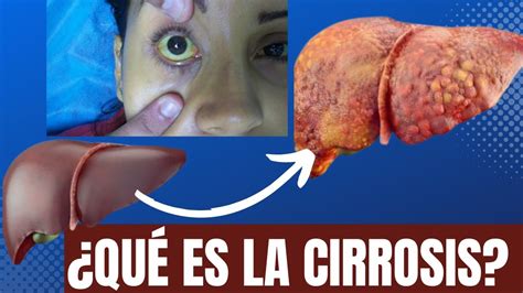 ¿qué Es La Cirrosis De Hígado Youtube