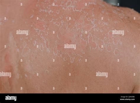 Skin Texture Background With Flaking Cell Scales After Sunburn And