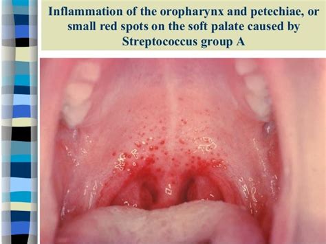 Lecture 3 Streptococcus Pyogenes