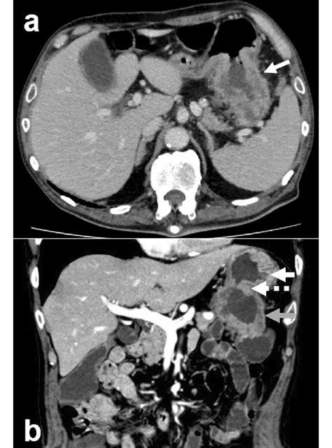 A Computed Tomography Revealed A Tumor In The Splenic Flexure Of The