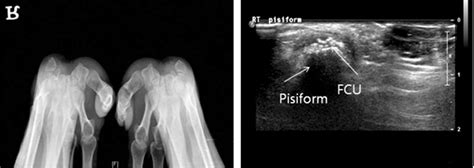 radiograph  ultrasonograph   patient  tendonitis  flexor