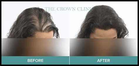 Hair Treatment Before And After Gallery Crown Clinic