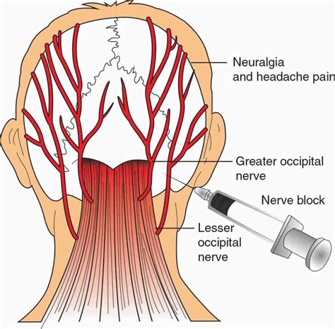 Nerve block uses, duration, nerve block procedure & side effects