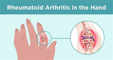 What Causes Arthritis In Fingers? - WireCandy