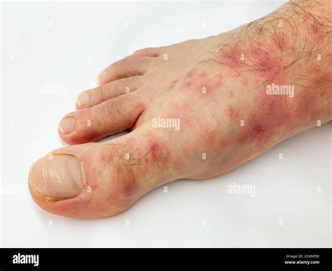 Close Up Of Male S Foot And Toes With Red Rash Desease On A White