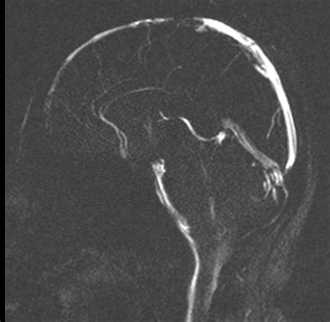 Cerebrospinal fluid flow MRI | CSF flow MRI protocol and planning