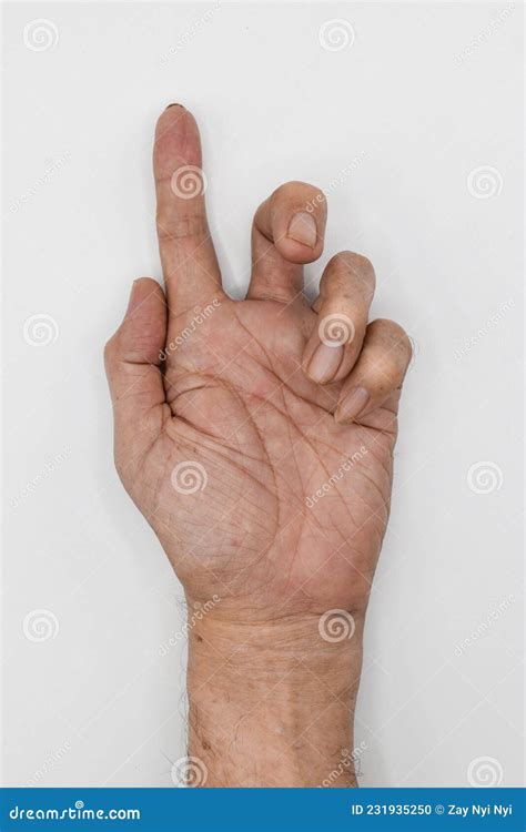 Ulnar Claw Hand Of Asian Elder Man Also Known As `spinster`s Claw