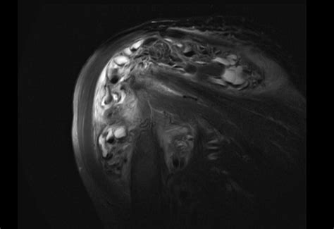 Tumoral Calcinosis Shoulder Image Radiopaedia Org