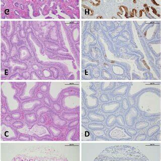 TUBB3 Expression In Colon Mucosa And Colonic Adenomas Was Examined By