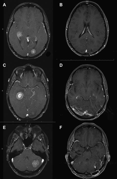 Surgical Management Of Brain Metastases Neupsy Key