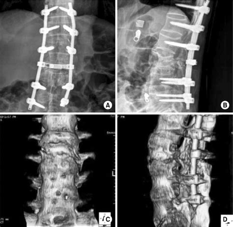 A∼d At A Postoperative 12 Weeks Anteroposterior And Lateral Plain