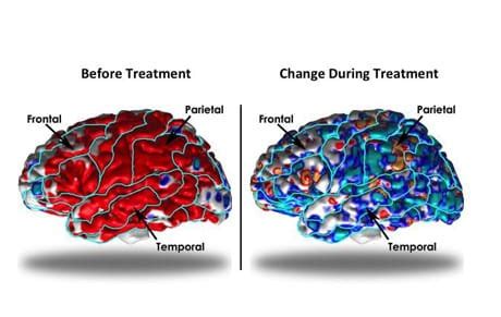 Cosa Succede Al Cervello Quando Si Va In Depressione Brainbook