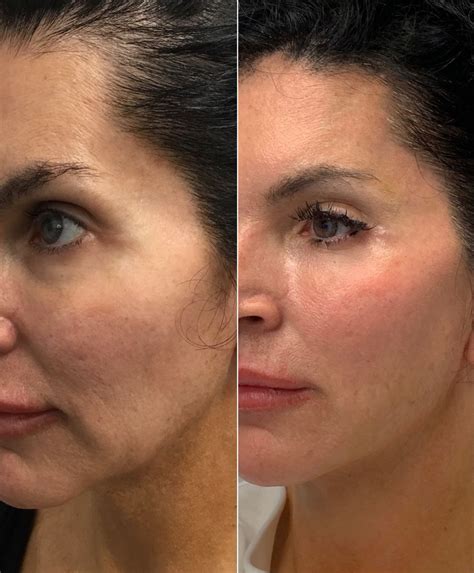 Cheek Fillers Botox Fillers Dermal Fillers Face Plastic Surgery