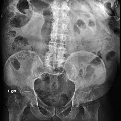 Urinary Bladder Hernia Image Radiopaedia Org