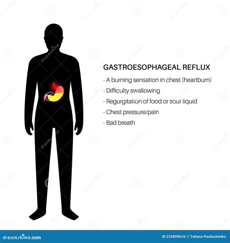 Gastroesophageal Reflux Disease Vector Illustration | CartoonDealer.com