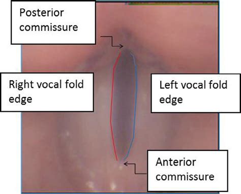 Laryngeal Image Of Vocal Folds In A Healthy Female For Interpretation