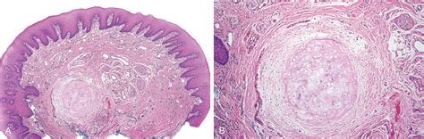 Fibrous And Gingival Nodules Clinical Tree