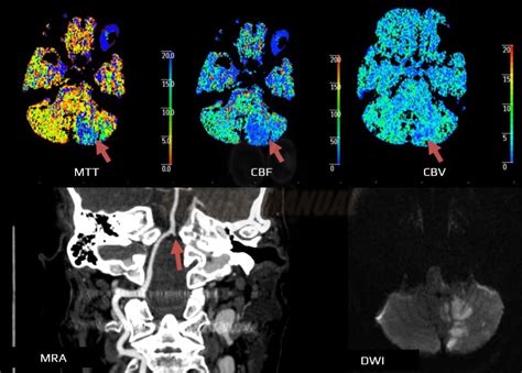 CT perfusion (CTP) | STROKE MANUAL