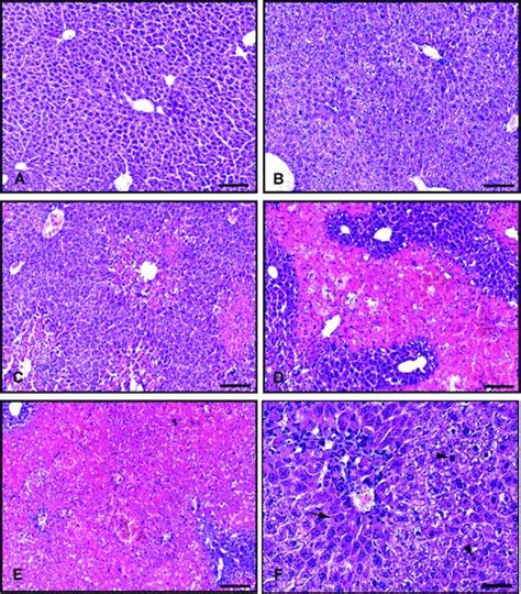 Liver Histopathology Depicting Grades Of Centrilobular Download Scientific Diagram