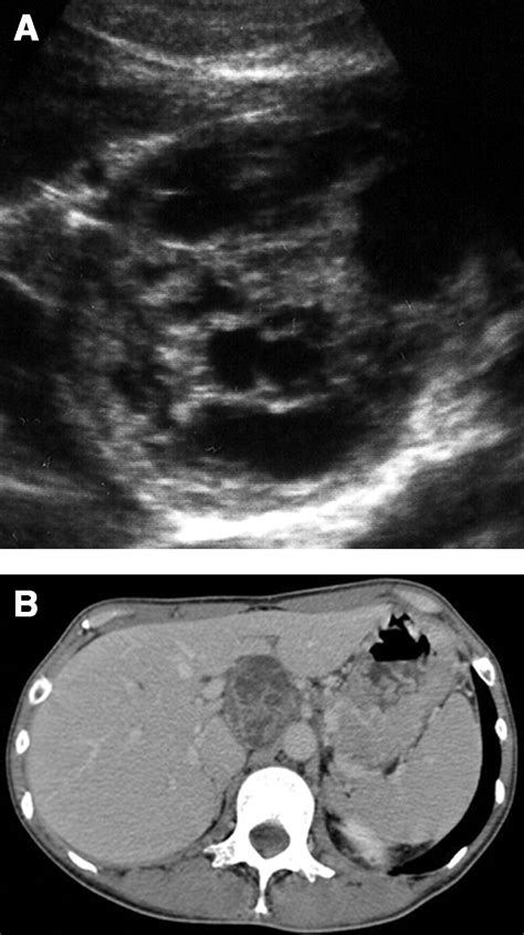 Retroperitoneal Benign Schwannoma In The Suprapancreatic Area