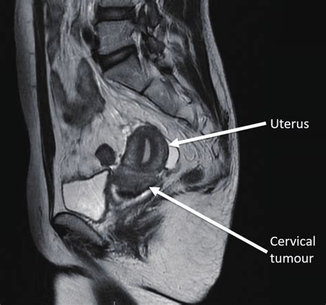 Sagittal T2 Weighted Magnetic Resonance Image Of The Female Pelvis