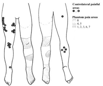 Journal Of Rehabilitation Medicine Phantom Limb Pain Relief By