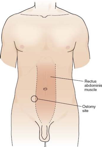 Loop Ileostomy Closure