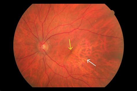 Retina Pigment Epithelial Tears